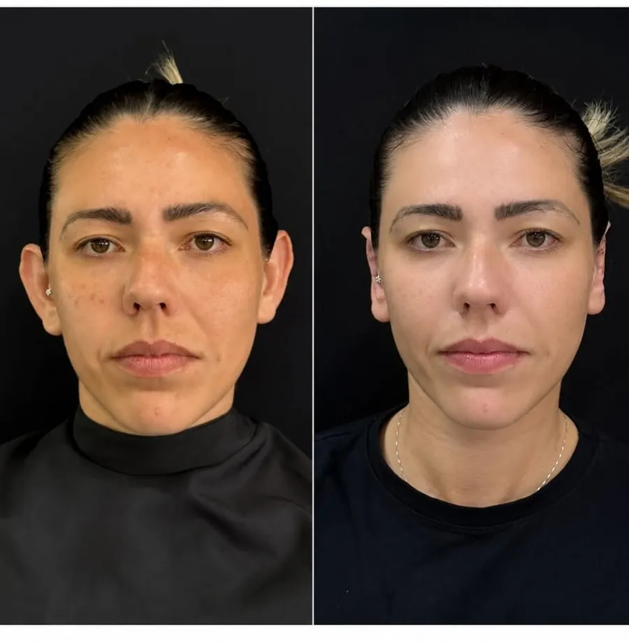 Rosto de paciente antes e depois da harmonização orofacial